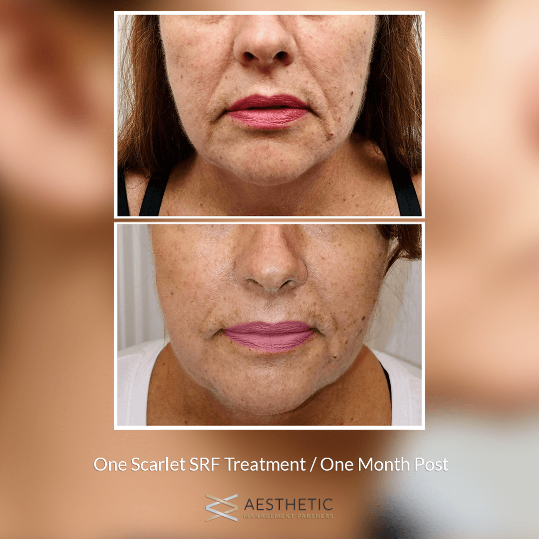 Scarlet Instant Face Lift Before & After Picture